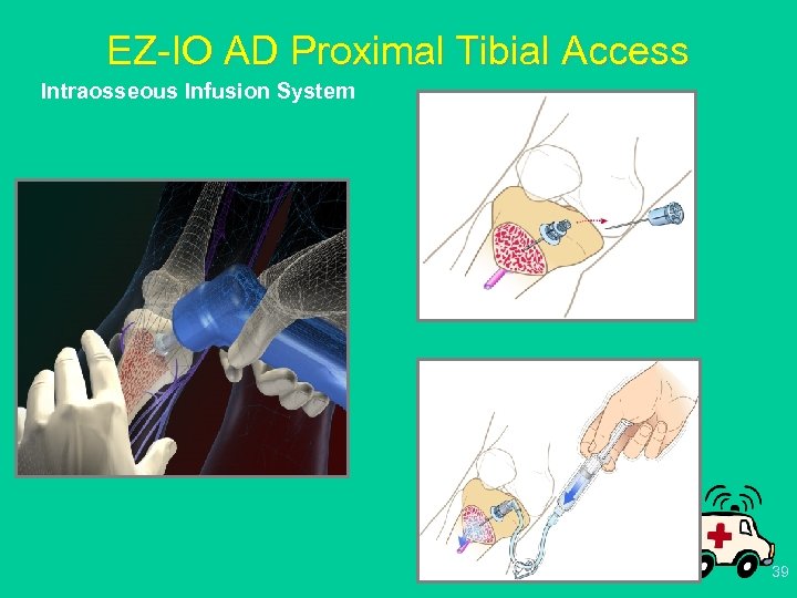 EZ-IO AD Proximal Tibial Access Intraosseous Infusion System 39 