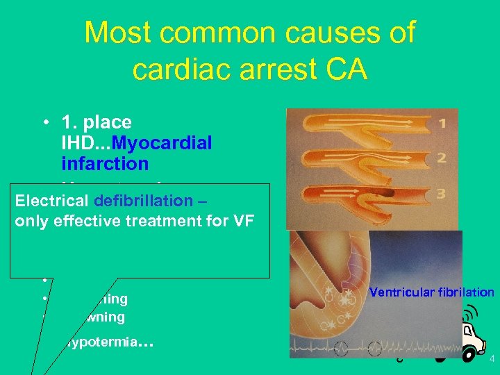 Most common causes of cardiac arrest CA • 1. place IHD. . . Myocardial