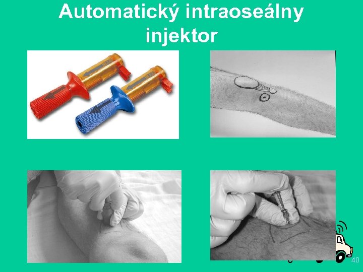 Automatický intraoseálny injektor 40 