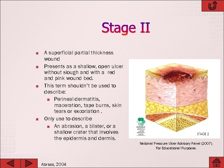 Stage II A superficial partial thickness wound Presents as a shallow, open ulcer without