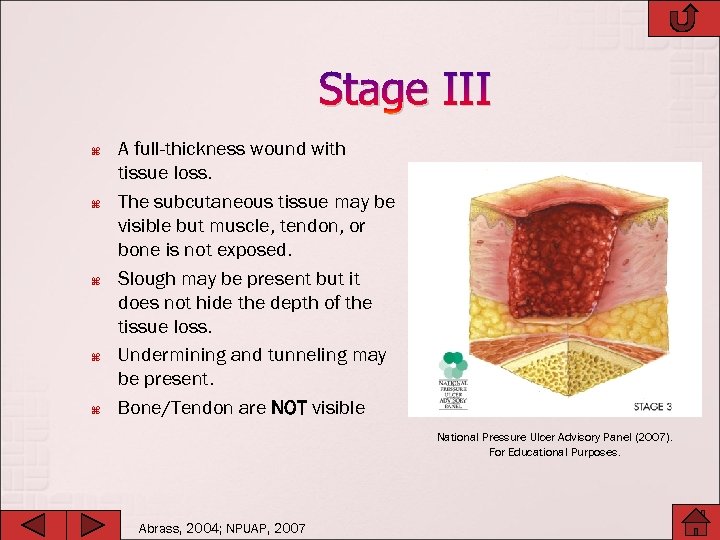 Stage III A full-thickness wound with tissue loss. The subcutaneous tissue may be visible