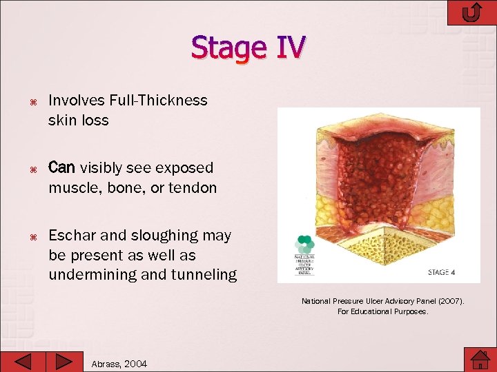 Stage IV Involves Full-Thickness skin loss Can visibly see exposed muscle, bone, or tendon