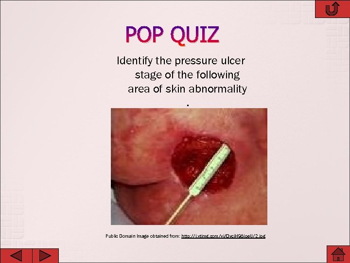 POP QUIZ Identify the pressure ulcer stage of the following area of skin abnormality.