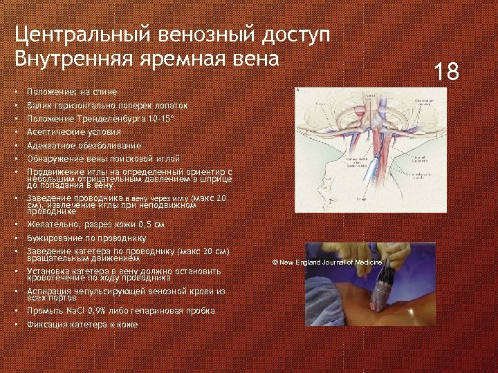 Центральный венозный доступ Внутренняя яремная вена • • • • Положение: на спине Валик