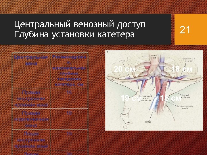 Центральных венах. Центральный венозный доступ. Постановка центральной вены. Глубина установки центрального венозного катетера.