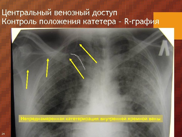 Центральный венозный доступ Контроль положения катетера – R-графия Непреднамеренная катетеризация внутренней яремной вены 24
