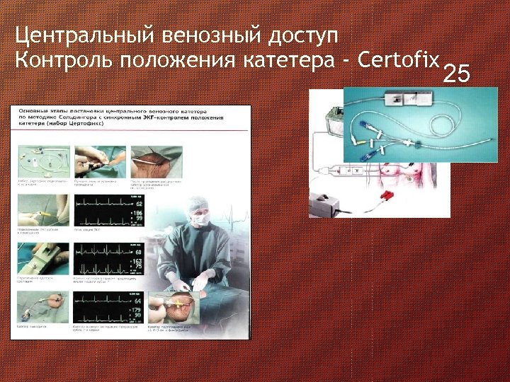 Центральный венозный доступ Контроль положения катетера - Certofix 25 