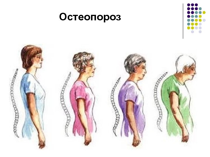 Остеопороз 
