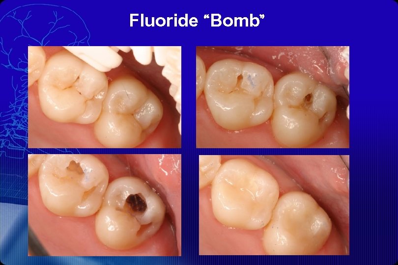 Fluoride “Bomb” 