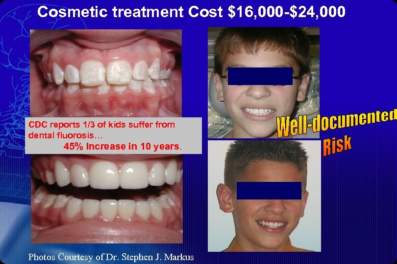 Cosmetic treatment Cost $16, 000 -$24, 000 CDC reports 1/3 of kids suffer from