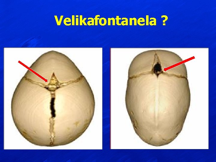 Velikafontanela ? 