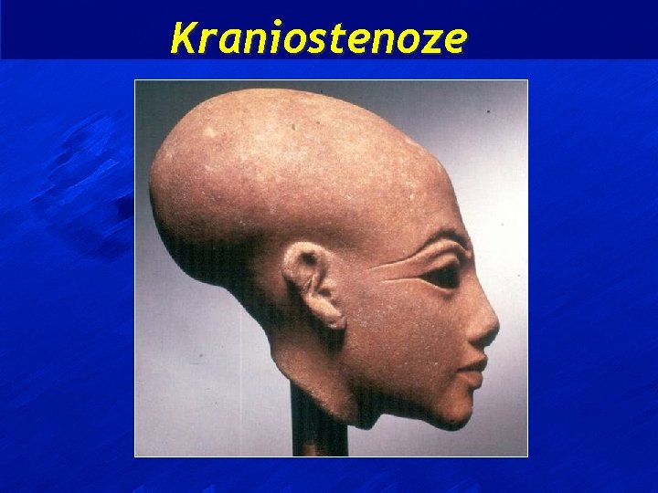 Kraniostenoze 