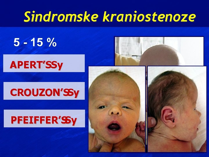 Sindromske kraniostenoze 5 - 15 % APERT’SSy CROUZON’SSy PFEIFFER’S Sy 