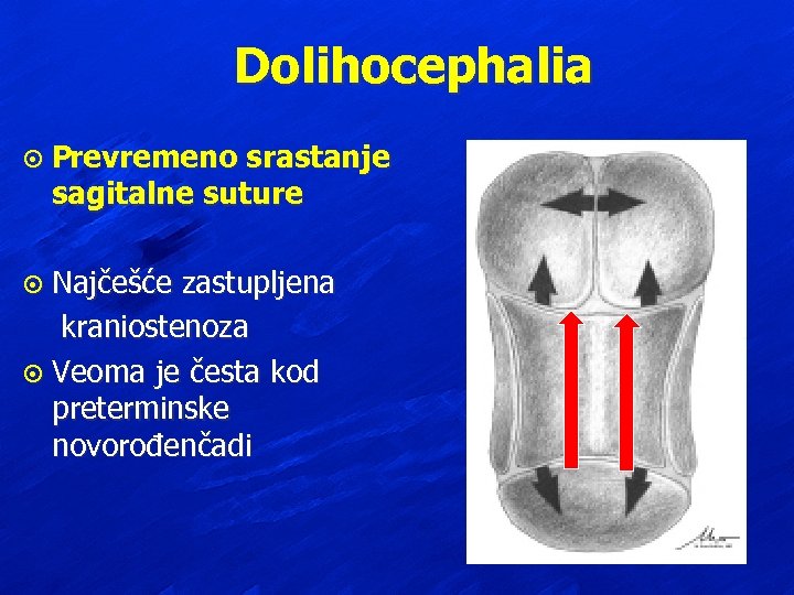 Dolihocephalia ¤ Prevremeno srastanje sagitalne suture Najčešće zastupljena kraniostenoza ¤ Veoma je česta kod