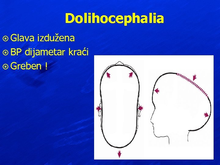 Dolihocephalia ¤ Glava izdužena ¤ BP dijametar kraći ¤ Greben ! 