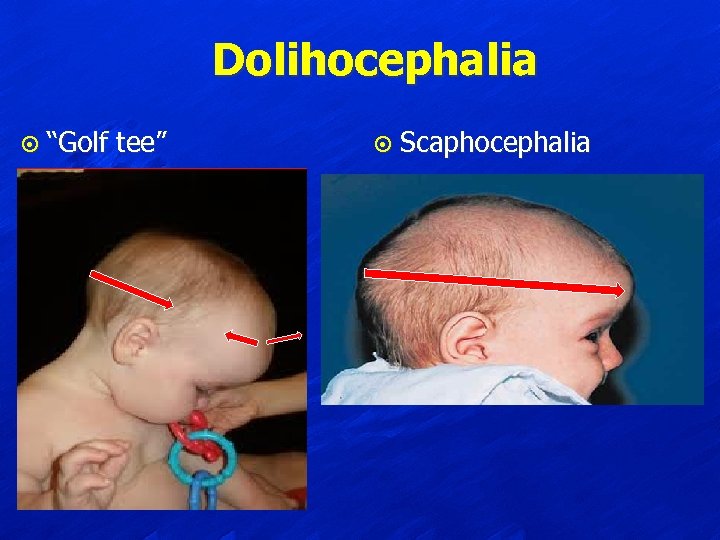 Dolihocephalia ¤ “Golf tee” ¤ Scaphocephalia 