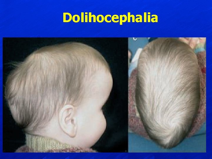 Dolihocephalia 