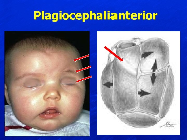 Plagiocephalia anterior 