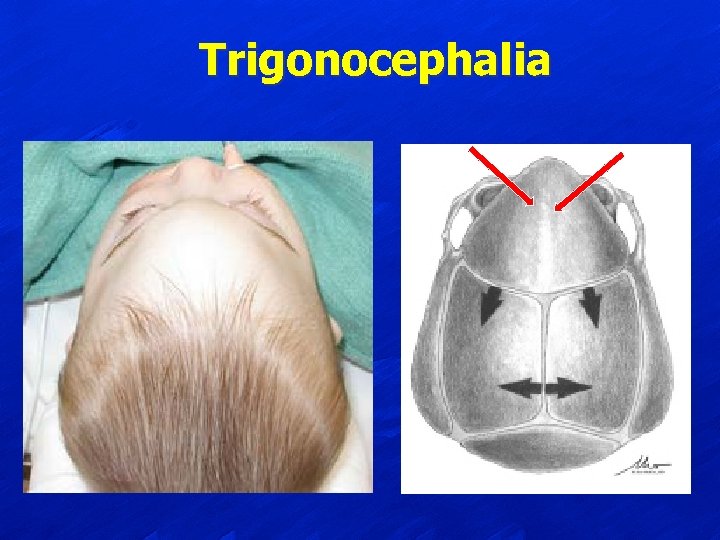 Trigonocephalia 