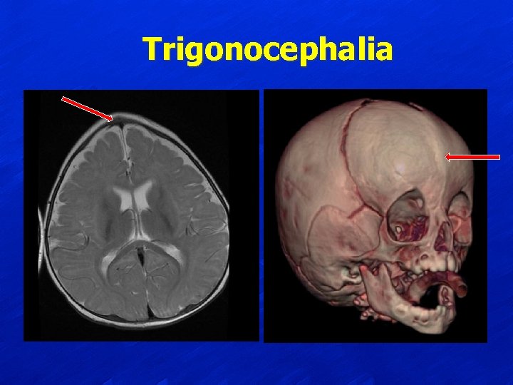 Trigonocephalia 