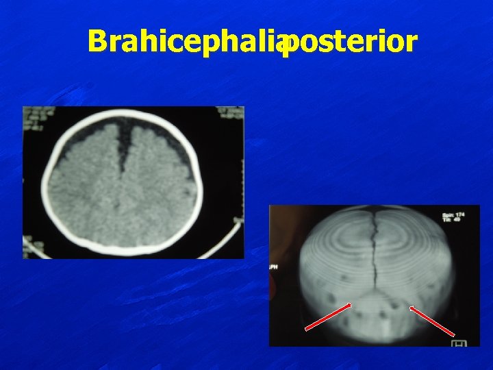 Brahicephalia posterior 