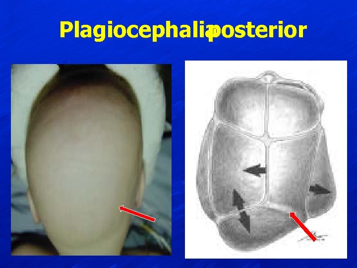 Plagiocephalia posterior 