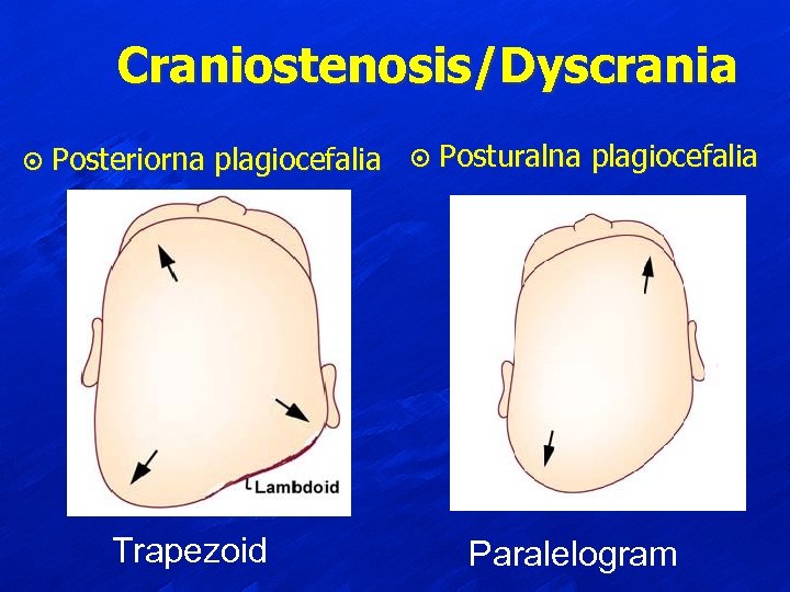 Craniostenosis/Dyscrania ¤ Posteriorna plagiocefalia Trapezoid ¤ Posturalna plagiocefalia Paralelogram 