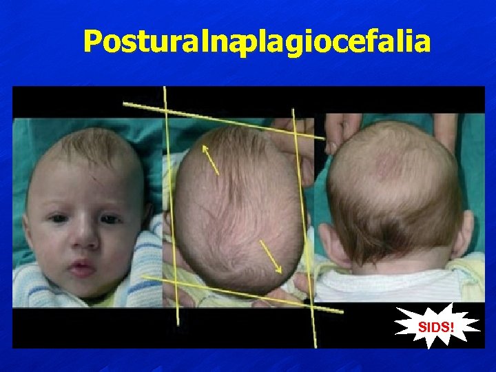 Posturalna plagiocefalia SIDS! 