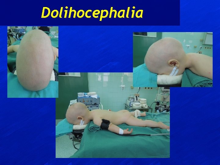 Dolihocephalia 