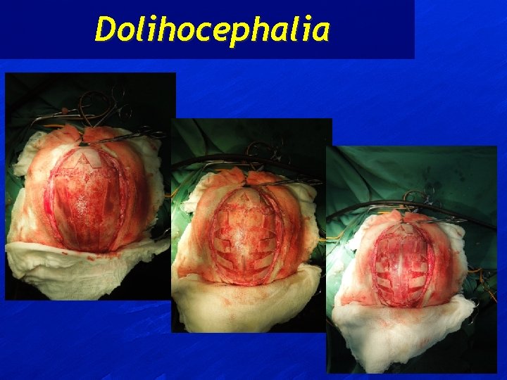 Dolihocephalia 