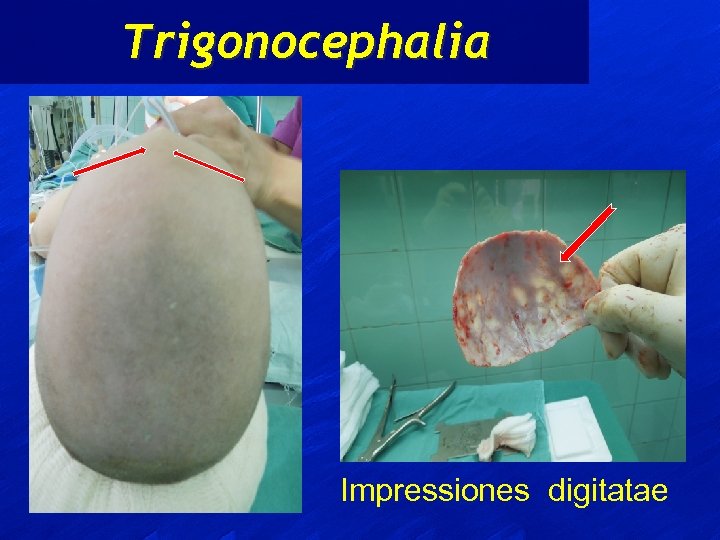 Trigonocephalia Impressiones digitatae 