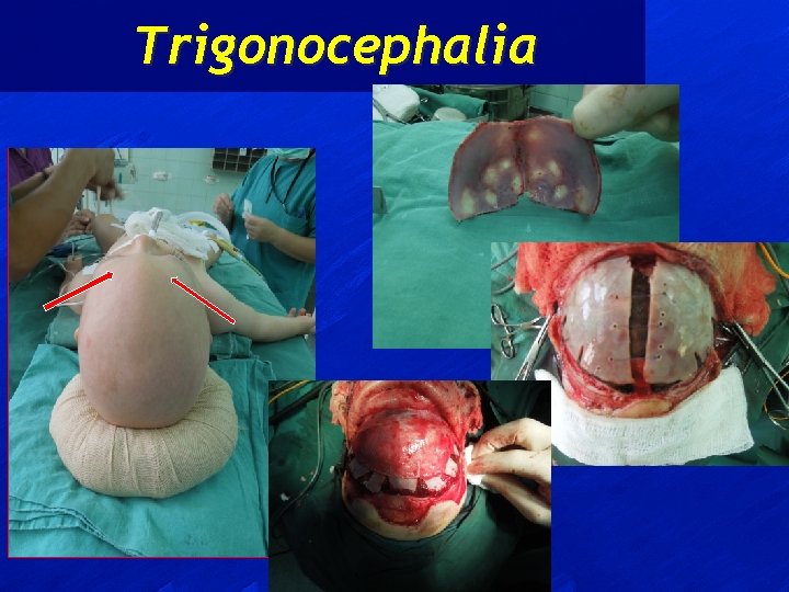 Trigonocephalia 