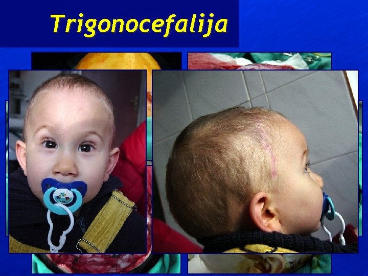 Trigonocefalija 