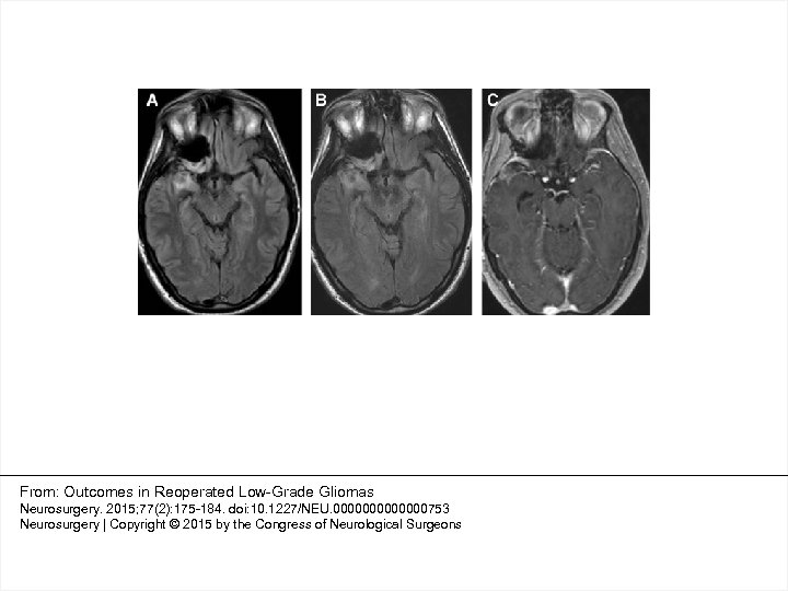 From: Outcomes in Reoperated Low-Grade Gliomas Neurosurgery. 2015; 77(2): 175 -184. doi: 10. 1227/NEU.
