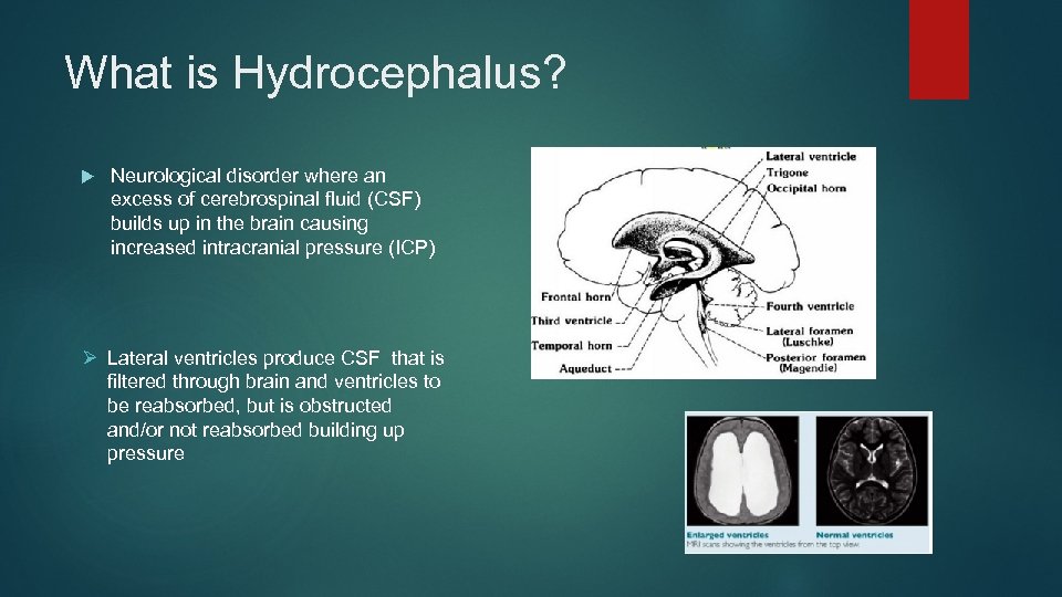 What is Hydrocephalus? Neurological disorder where an excess of cerebrospinal fluid (CSF) builds up