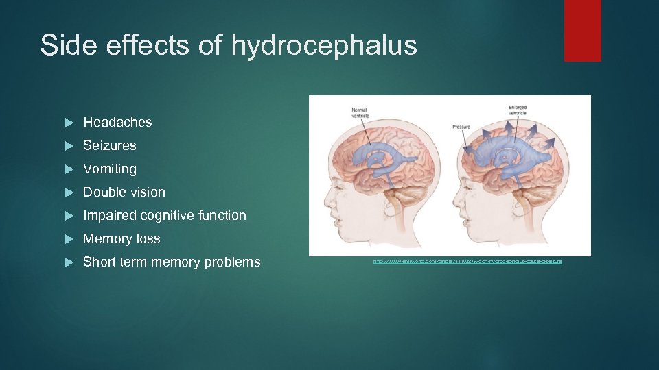 Side effects of hydrocephalus Headaches Seizures Vomiting Double vision Impaired cognitive function Memory loss