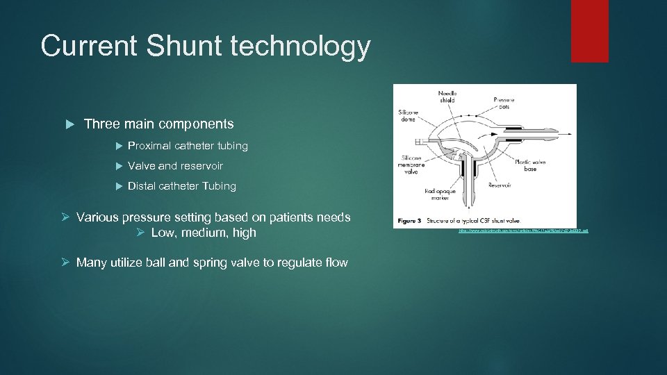 Current Shunt technology Three main components Proximal catheter tubing Valve and reservoir Distal catheter