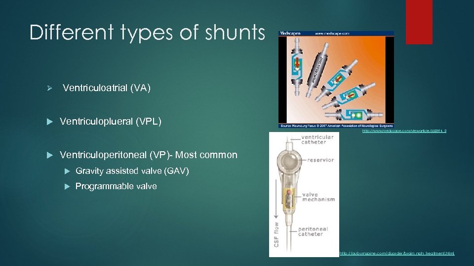 Different types of shunts Ø Ventriculoatrial (VA) Ventriculoplueral (VPL) http: //www. medscape. com/viewarticle/558974_2 Ventriculoperitoneal
