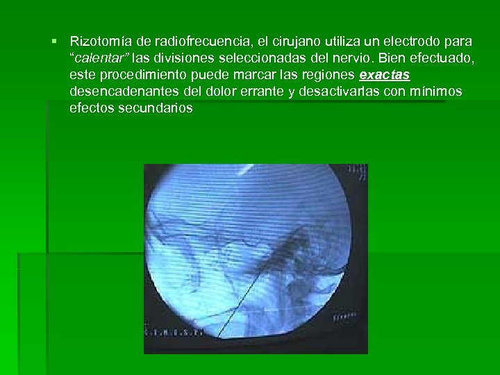§ Rizotomía de radiofrecuencia, el cirujano utiliza un electrodo para “calentar” las divisiones seleccionadas