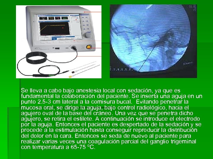 Se lleva a cabo bajo anestesia local con sedación, ya que es fundamental la