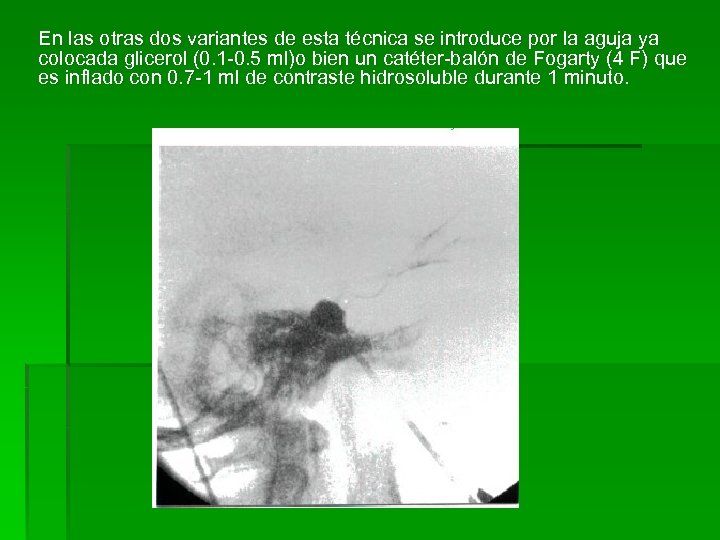 En las otras dos variantes de esta técnica se introduce por la aguja ya