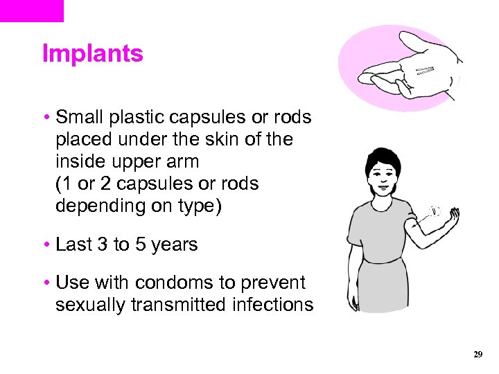 Implants • Small plastic capsules or rods placed under the skin of the inside