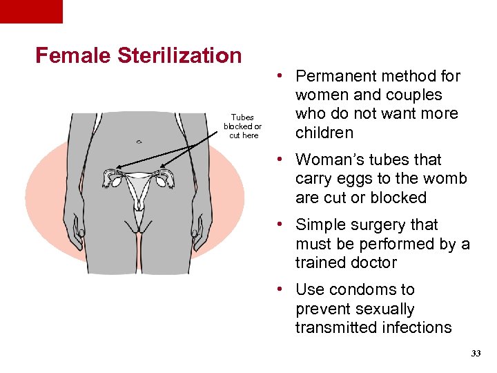 Female Sterilization Tubes blocked or cut here • Permanent method for women and couples