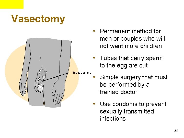 Vasectomy • Permanent method for men or couples who will not want more children