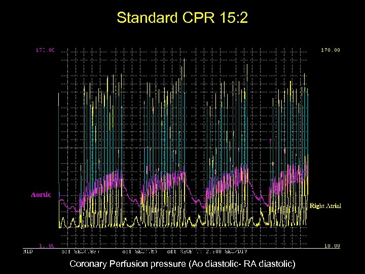 Standard CPR 15: 2 Coronary Perfusion pressure (Ao diastolic- RA diastolic) 