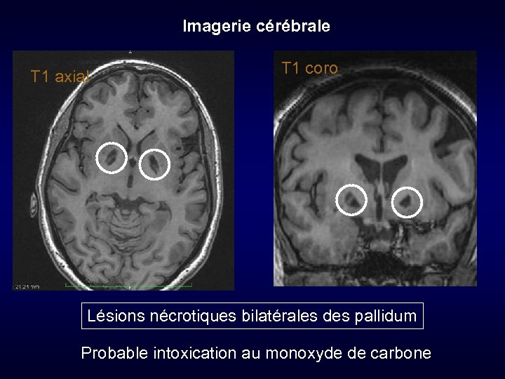 Imagerie cérébrale T 1 axial T 1 coro Lésions nécrotiques bilatérales des pallidum Probable