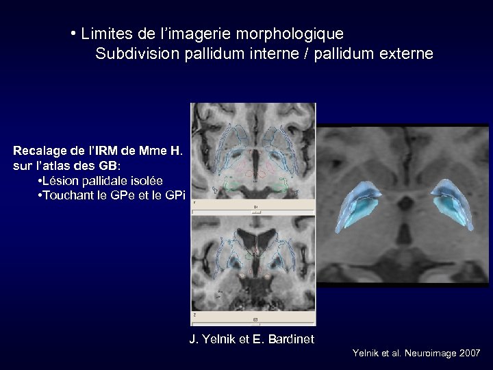  • Limites de l’imagerie morphologique Subdivision pallidum interne / pallidum externe Recalage de