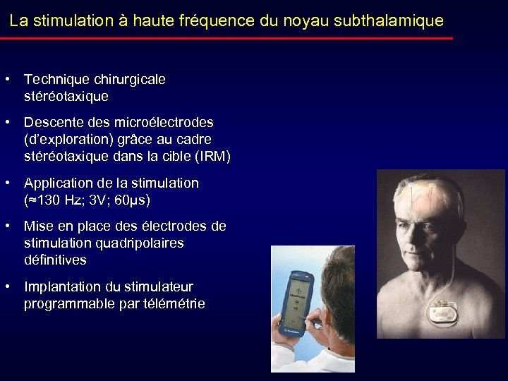La stimulation à haute fréquence du noyau subthalamique • Technique chirurgicale stéréotaxique • Descente