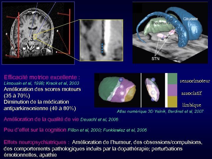Efficacité motrice excellente : sensorimoteur Limousin et al, 1998; Krack et al, 2003 Amélioration