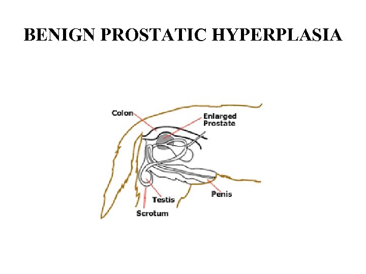 BENIGN PROSTATIC HYPERPLASIA 